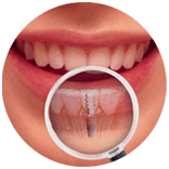 implants-exsm